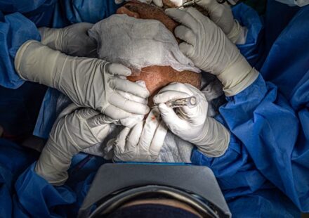 Hair Transplant