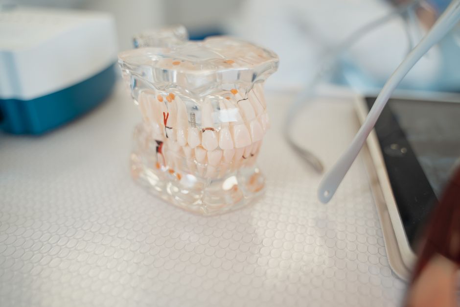implantes dentales precio